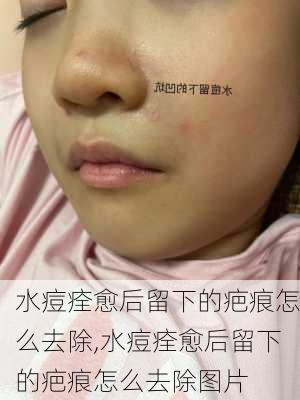 水痘痊愈后留下的疤痕怎么去除,水痘痊愈后留下的疤痕怎么去除图片